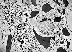 F,46y. | large keratohyalin granules in epidermal cells - verruca vulgaris F,46y. | large keratohyalin granules in epidermal cells - verruca vulgaris